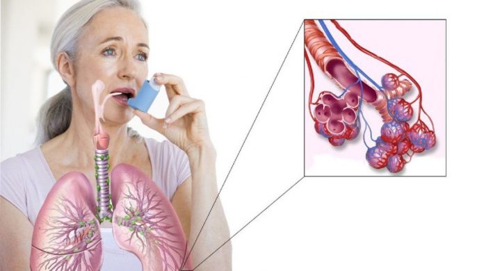 Вчені наблизилися до повного лікування бронхіальної астми